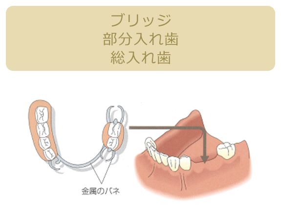 ブリッジ部分入れ歯総入れ歯