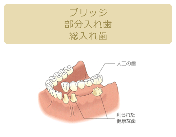 ブリッジ部分入れ歯総入れ歯