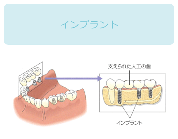 インプラント