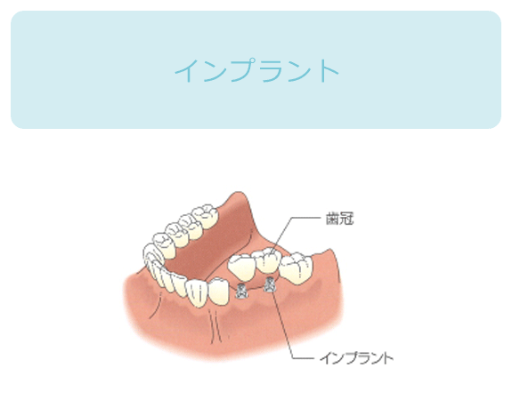 インプラント