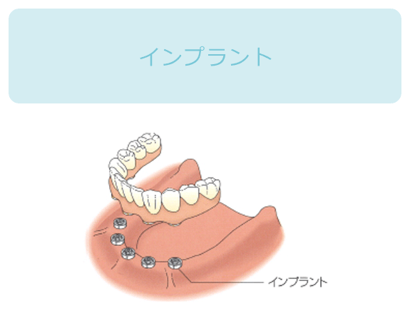 インプラント