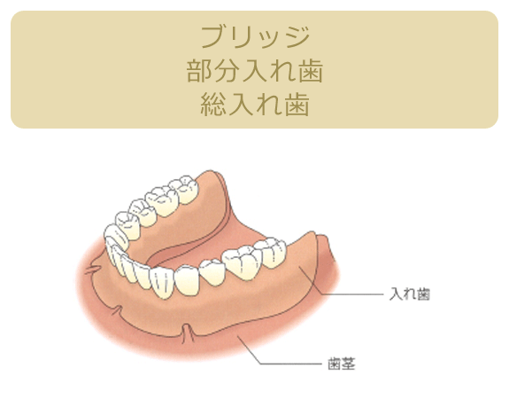 ブリッジ部分入れ歯総入れ歯